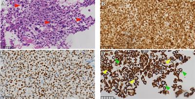 Prevalence and clinical characteristics of Crooke’s cell adenomas in 101 patients with T-PIT-positive pituitary adenomas: Case series and literature review